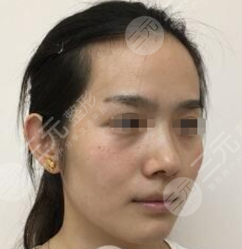 上海伊尔美医疗美容医院注射美白案例