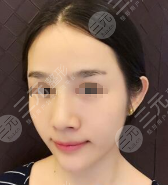 上海伊尔美医疗美容医院注射美白案例