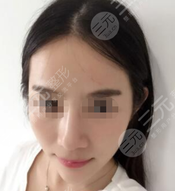 上海伊尔美医疗美容医院注射美白案例