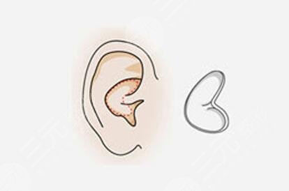 耳软骨隆鼻适合人群