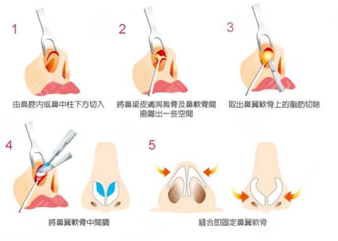 肥厚鼻尖矫正术方法原理