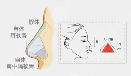 分段式假体隆鼻什么意思？美鼻宝典带你认识ta！
