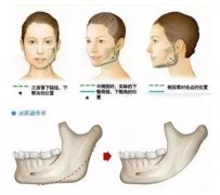 女士肥胖下颌角整形手术科普！柔媚轮廓就靠它，攻略分享~