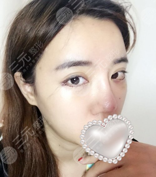 开外眼角3mm图片