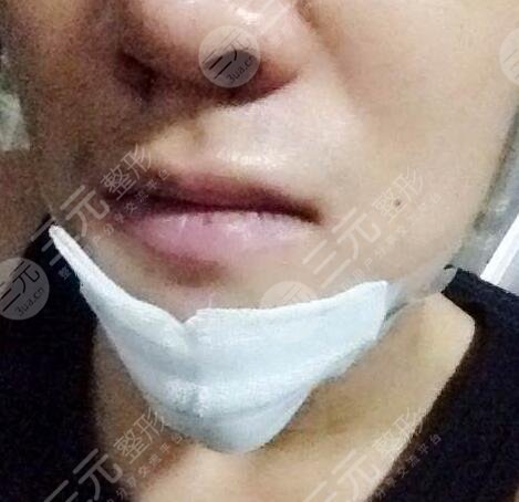 哪些因素影响了隆下巴的收费价格标准?