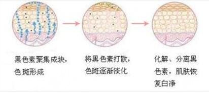 激光祛斑术后护理注意事项