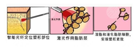 不适合做吸脂手术的人群