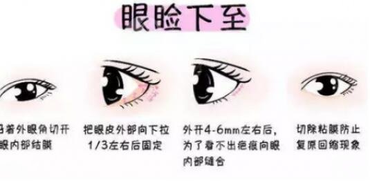上睑下垂怎么办