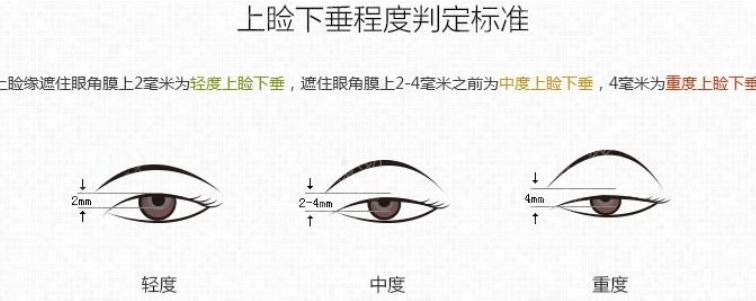 上睑下垂怎么办
