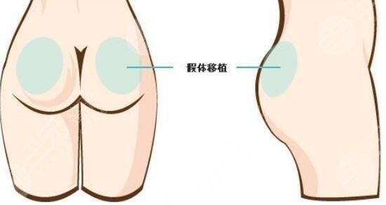 吸脂提臀手术后注意事项