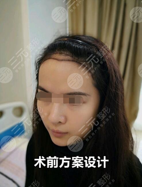 种植头发手术前