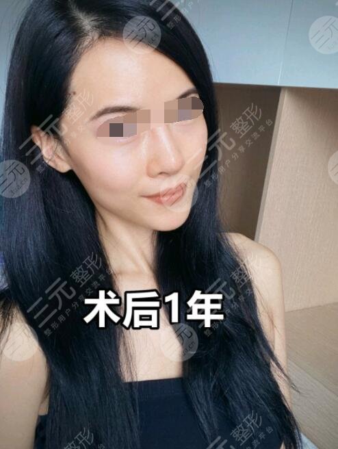 种植头发手术后