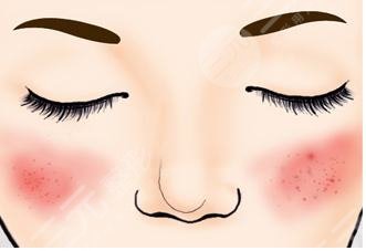 脸上红血丝如何去除？怎么修复？