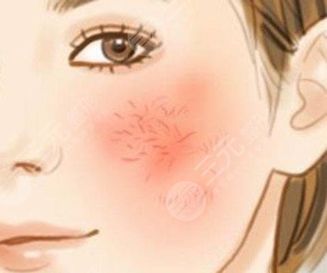 脸上红血丝如何去除？怎么修复？