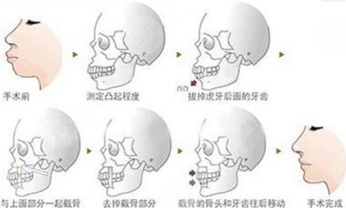 正颌手术是什么？正颌手术详细步骤解析+注意事项
