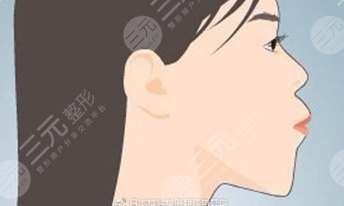 正颌手术是什么