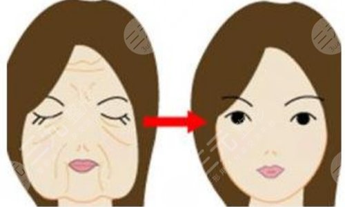 拉皮除皱是什么