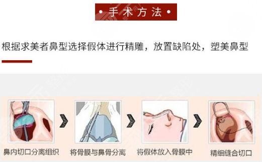 硅胶隆鼻手术副作用严重吗？科普整形风险，小白必看！