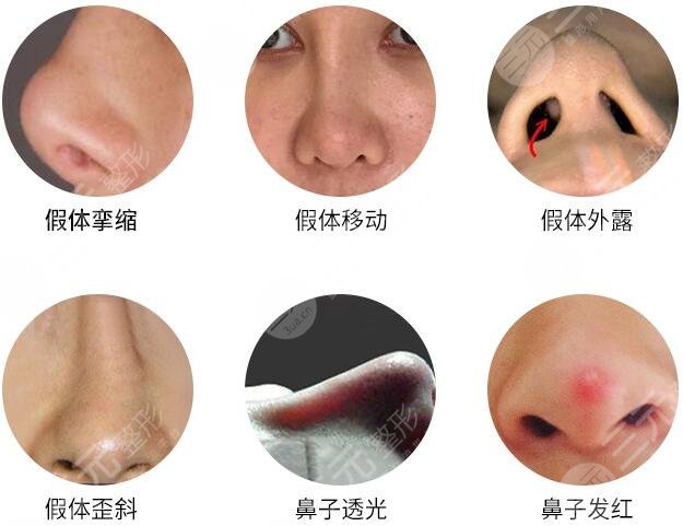 硅胶隆鼻手术副作用
