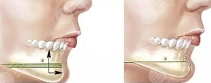 下巴截骨前移果怎么样