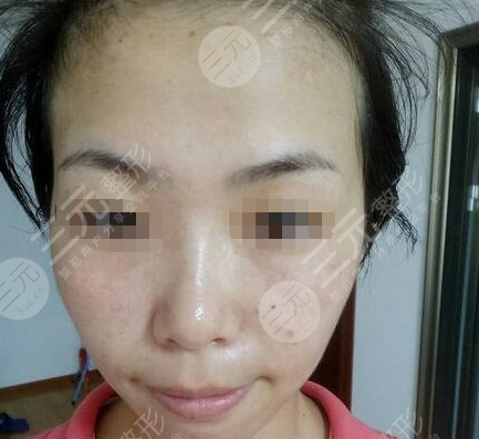 九院激光pm激光祛斑价格