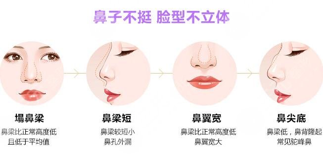 朝天短鼻整形手术
