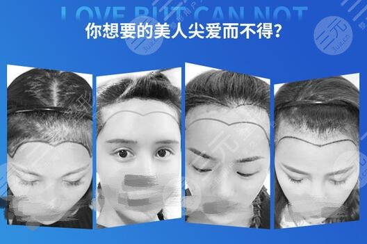 美人尖整形手术科普!魅力发际线修饰脸型,少不了这个尖! 美人尖整形手术科普!魅力发际线修饰脸型,少不了这个尖!
