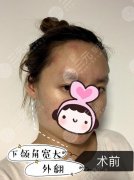下颌角手术恢复全过程记录，没有比这更详细的了，集美们快来！