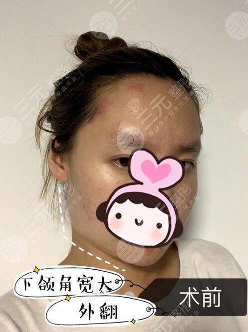 下颌角手术恢复全过程记录，没有比这更详细的了，集美们快来！