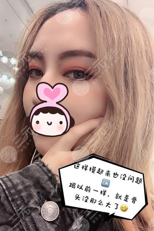 下颌角磨骨手术过程