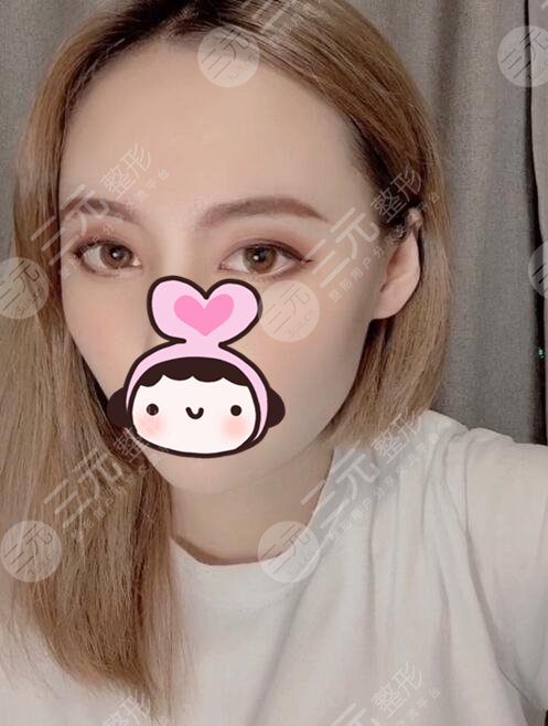 下颌角磨骨手术术后果