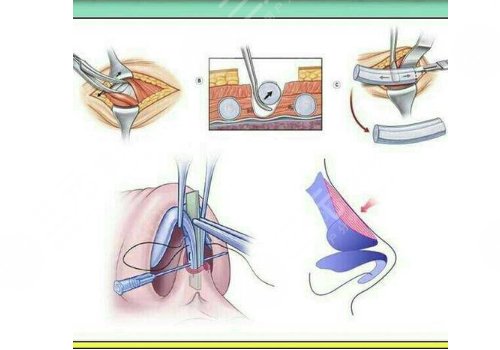 科普向：肋软骨隆鼻可以维持多久？小白都关心的肋软骨隆鼻那些事儿