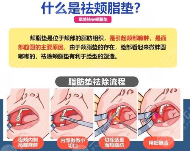 去颊脂垫