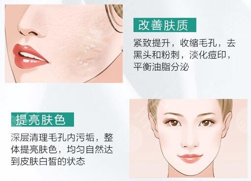 光子嫩肤有什么好处