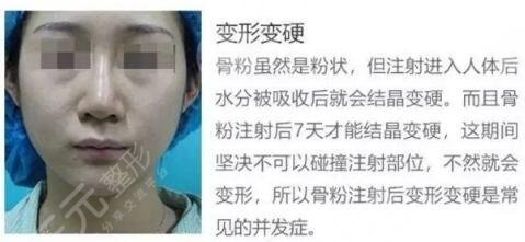 人工骨粉隆鼻的危害