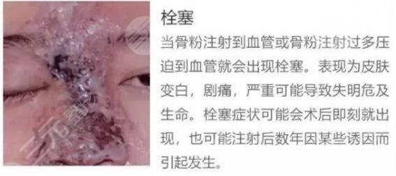 人工骨粉隆鼻