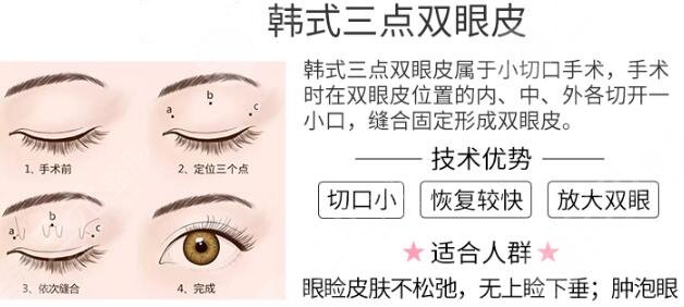 微创定点定位双眼皮原理