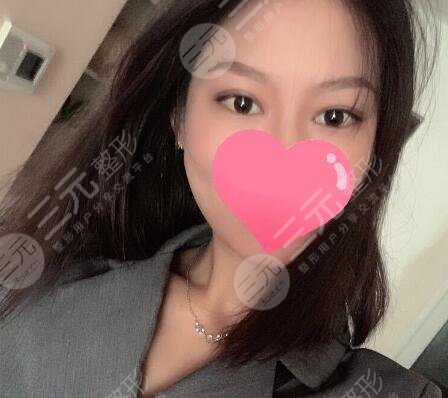 弓军胜双眼皮案例分享