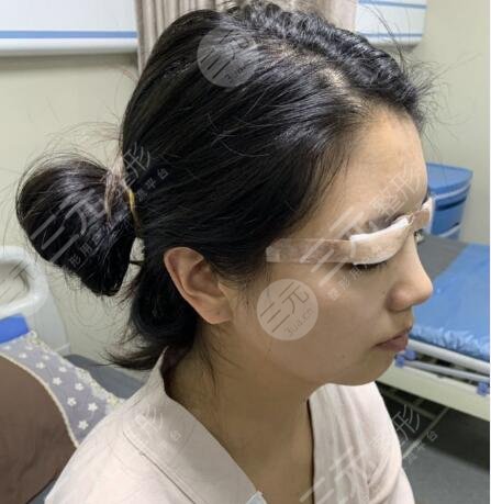 西京医院刘恒鑫医生做双眼皮案例图