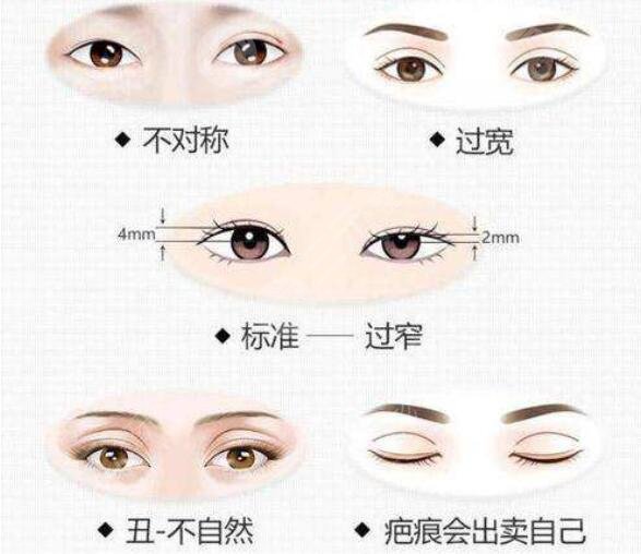 双眼皮修复术前准备事项