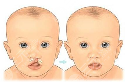 唇腭裂修复手术大概需要多少费用