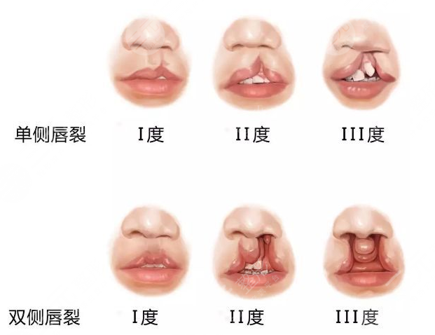 唇腭裂修复手术大概需要多少费用