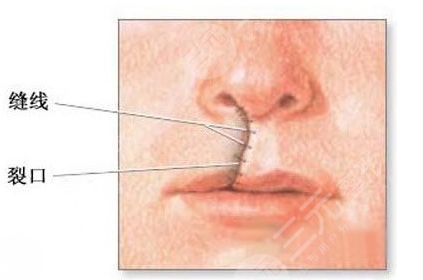 唇腭裂修复手术大概需要多少费用