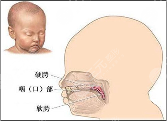 唇腭裂修复手术大概需要多少费用