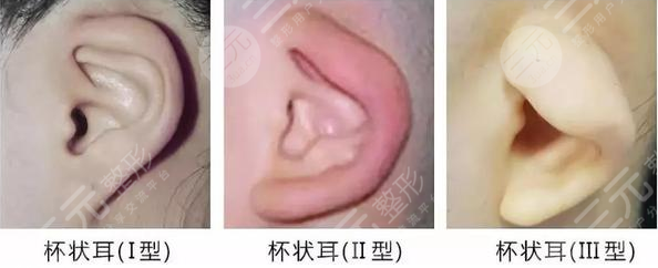 杯状耳矫正器价格