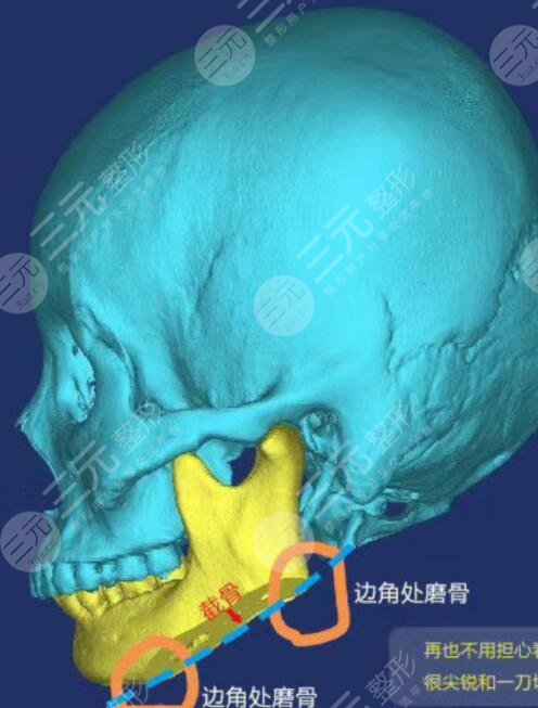 磨骨术后护理事项