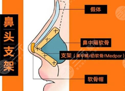 做肋骨鼻对身体有影响吗？有没有伤害？一文详细解析！快来看！