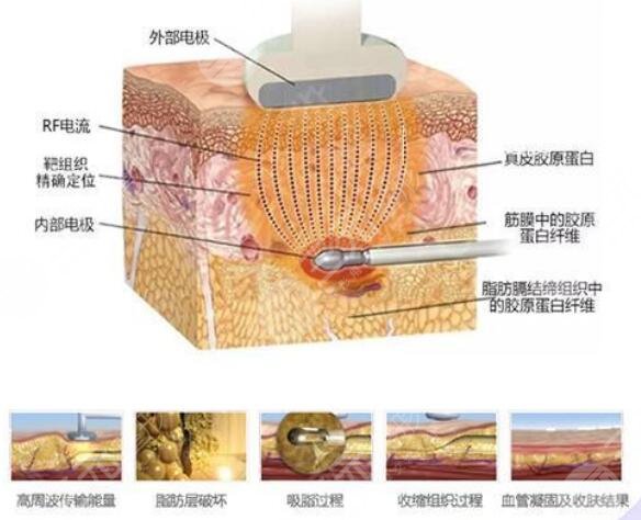 黄金微雕一次多少钱