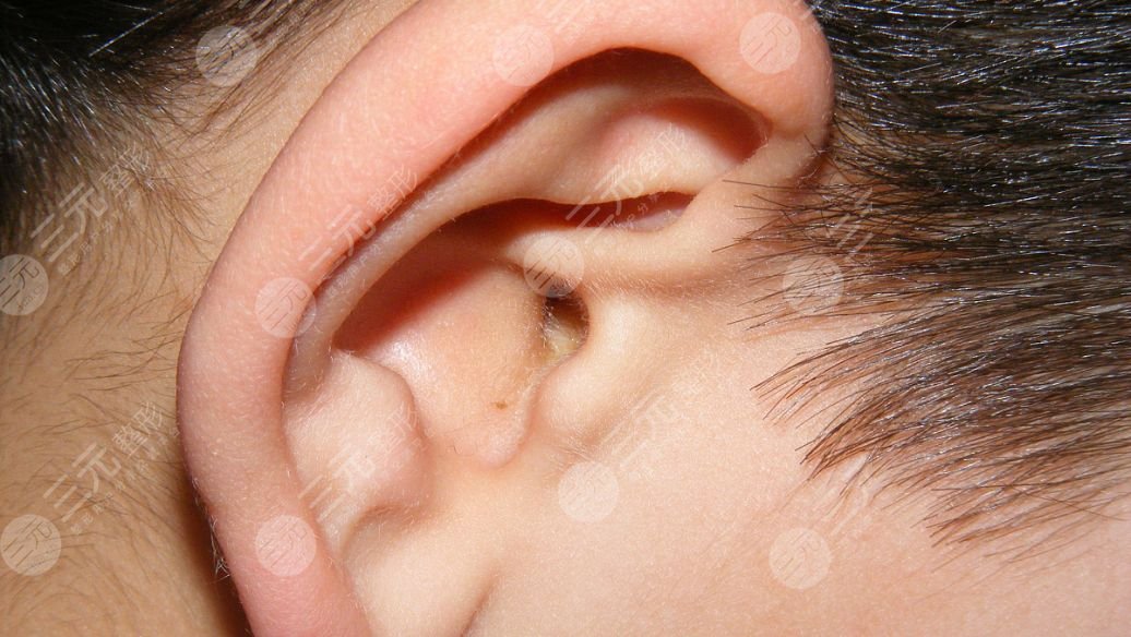 耳再造手术大概多少费用