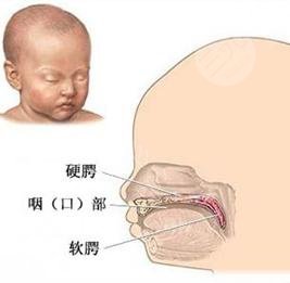 上海唇腭裂手术多少钱？费用价格参考及术后注意事项全讲解！